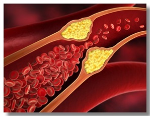Arteriosklerose schematische Darstellung